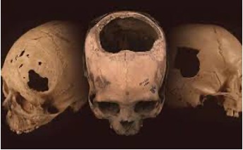 F31. Lobotomías de distintos orificios.